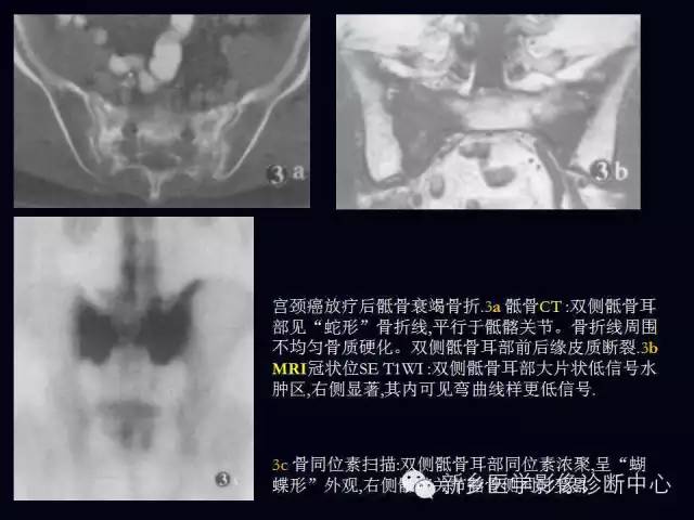 【病例】跖骨应力性骨折1例影像表现