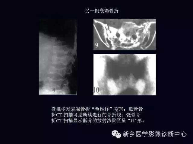 【病例】跖骨应力性骨折1例影像表现