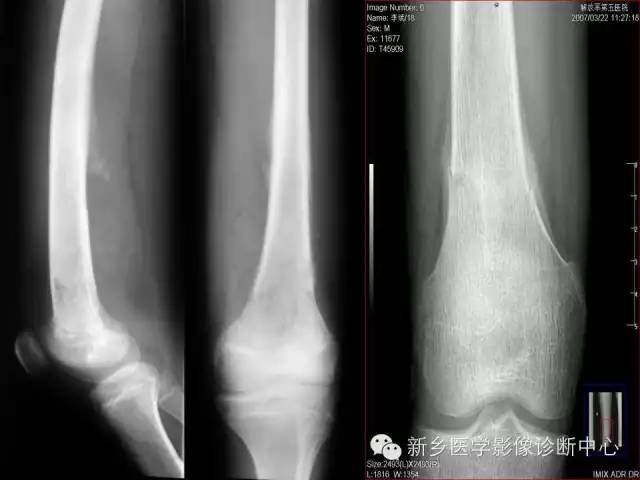 【病例】跖骨应力性骨折1例影像表现