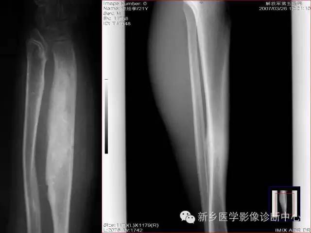 【病例】跖骨应力性骨折1例影像表现