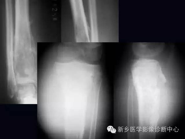 【病例】跖骨应力性骨折1例影像表现