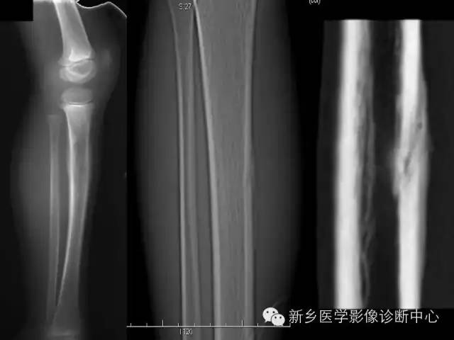 【病例】跖骨应力性骨折1例影像表现
