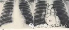 心脏三位片读片技巧