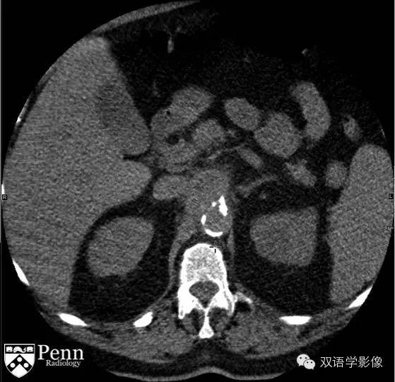 【病例】主动脉穿通性溃疡1例CT影像表现