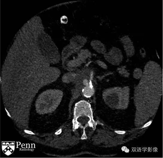 【病例】主动脉穿通性溃疡1例CT影像表现
