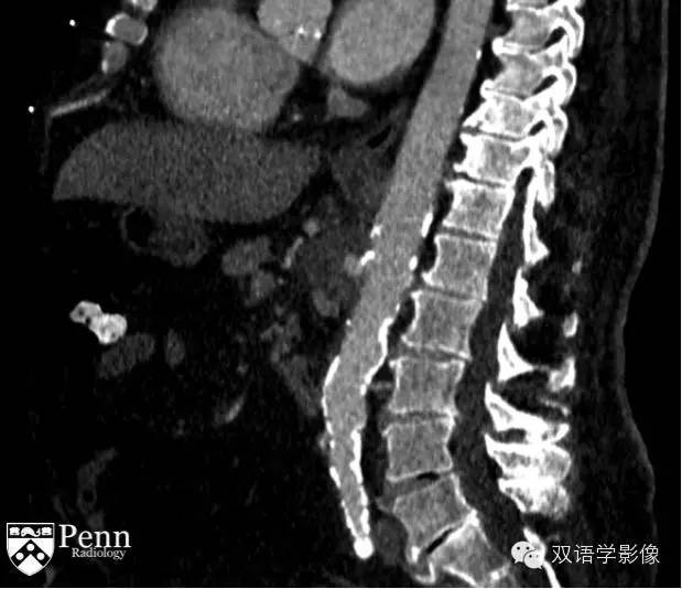 【病例】主动脉穿通性溃疡1例CT影像表现