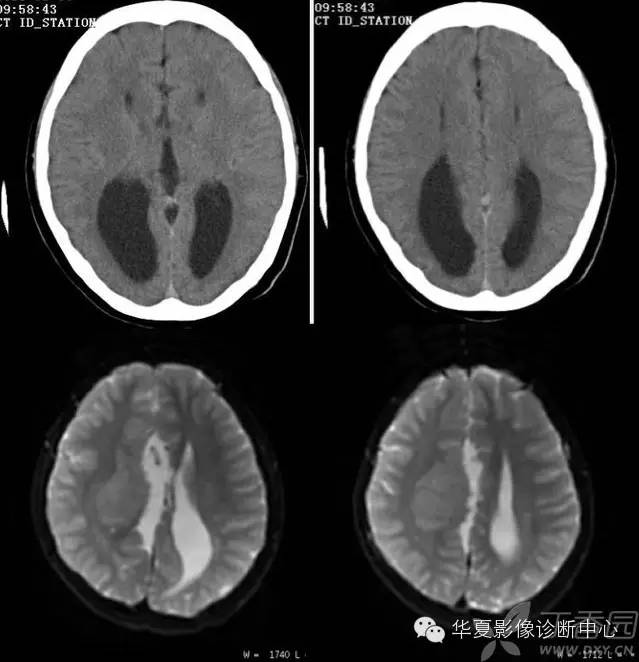 医学影像征象--解析汇集(神经系统部分) 医学影像征象--解析汇集(神经系统部分)