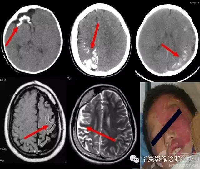 医学影像征象--解析汇集(神经系统部分) 医学影像征象--解析汇集(神经系统部分)