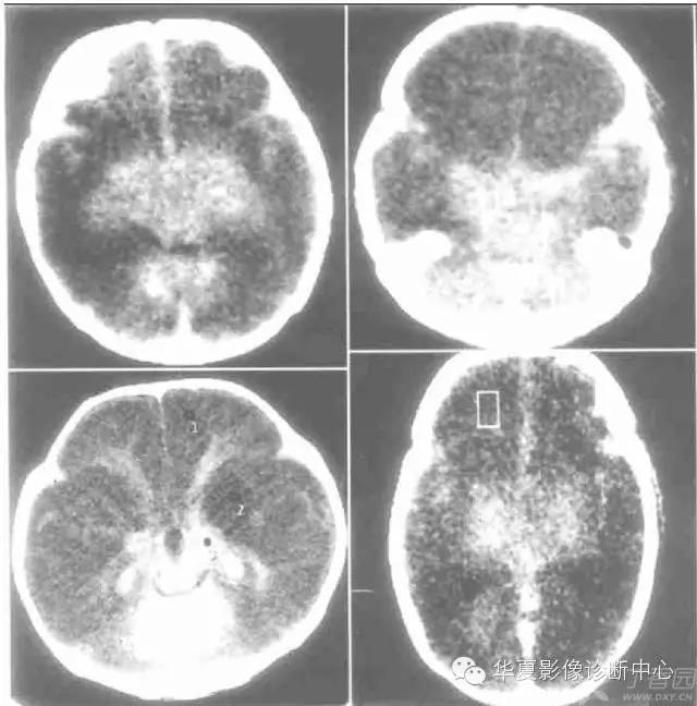 医学影像征象--解析汇集(神经系统部分) 医学影像征象--解析汇集(神经系统部分)