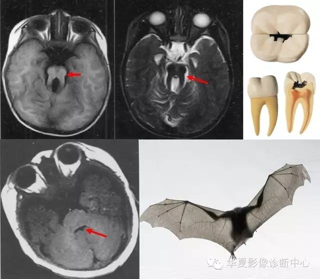医学影像征象--解析汇集(神经系统部分) 医学影像征象--解析汇集(神经系统部分)