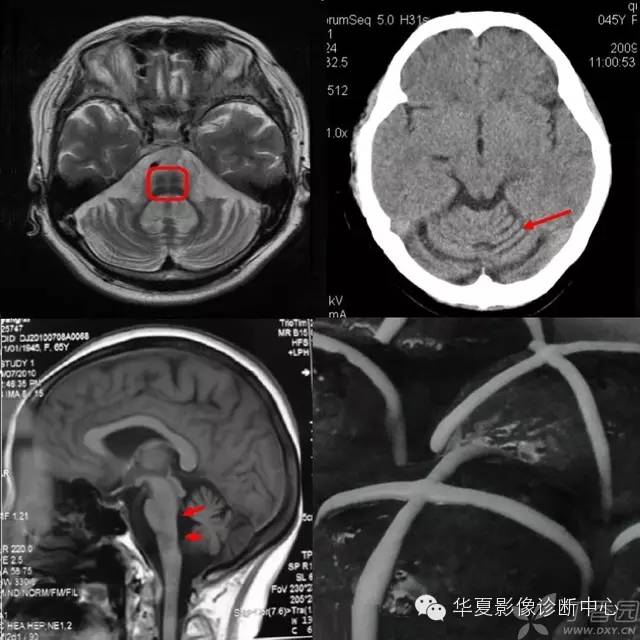 医学影像征象--解析汇集(神经系统部分) 医学影像征象--解析汇集(神经系统部分)