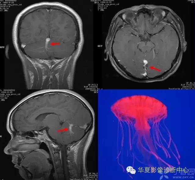 医学影像征象--解析汇集(神经系统部分) 医学影像征象--解析汇集(神经系统部分)