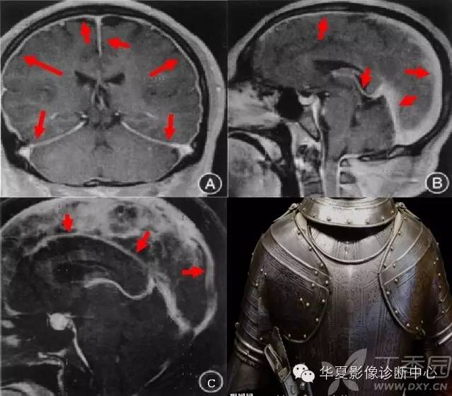 医学影像征象--解析汇集(神经系统部分) 医学影像征象--解析汇集(神经系统部分)