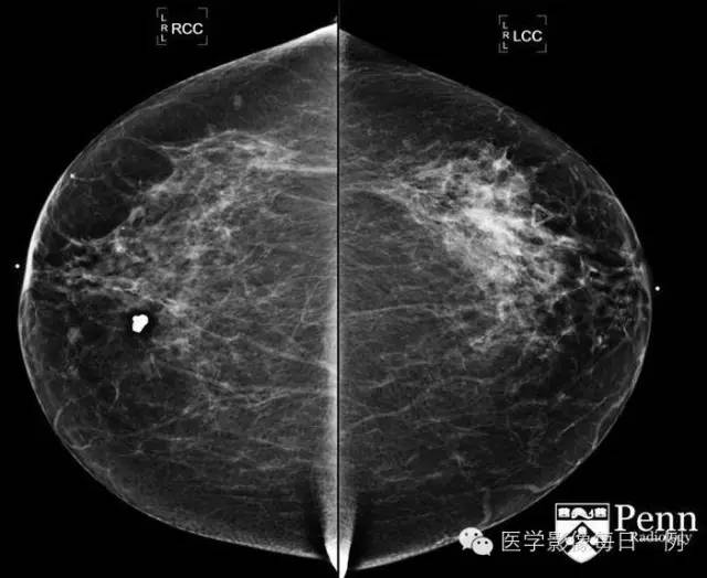 【病例】乳腺浸润性小叶癌1例