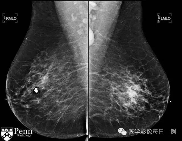【病例】乳腺浸润性小叶癌1例 【病例】乳腺浸润性小叶癌1例