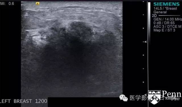 【病例】乳腺浸润性小叶癌1例 【病例】乳腺浸润性小叶癌1例