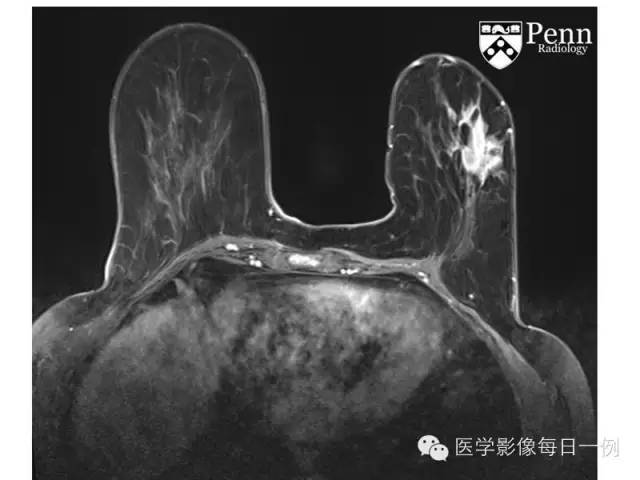 【病例】乳腺浸润性小叶癌1例 【病例】乳腺浸润性小叶癌1例