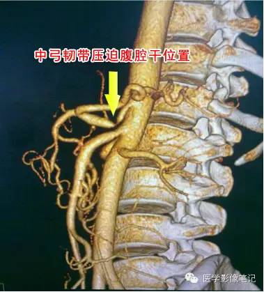 中弓状韧带压迫综合征