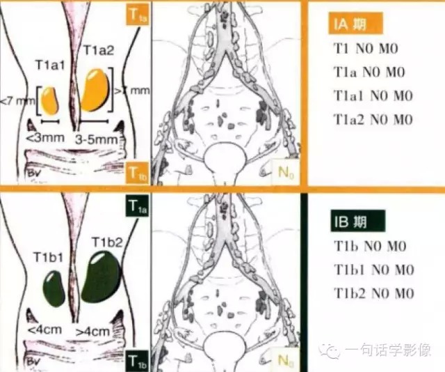 宫颈癌分期及图解
