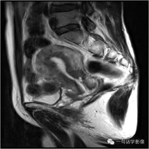 宫颈癌分期及图解