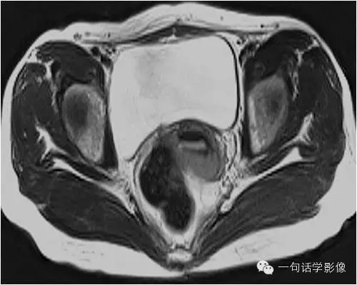 宫颈癌分期及图解