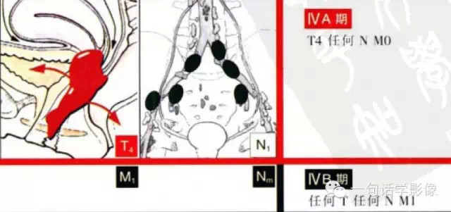 宫颈癌分期及图解