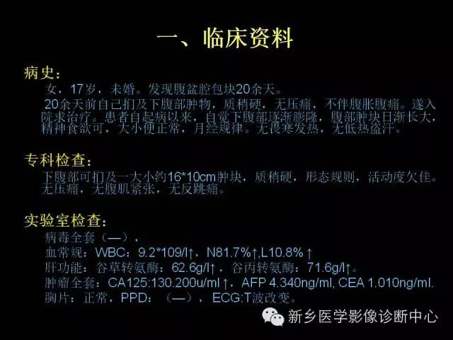 【病例】卵巢颗粒细胞瘤1例MR影像表现与鉴别