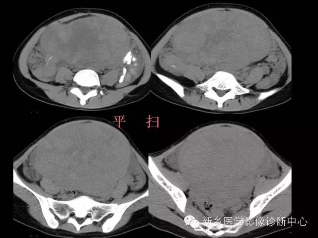 【病例】卵巢颗粒细胞瘤1例MR影像表现与鉴别