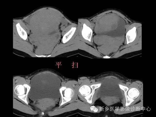 【病例】卵巢颗粒细胞瘤1例MR影像表现与鉴别