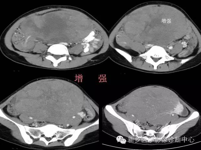 【病例】卵巢颗粒细胞瘤1例MR影像表现与鉴别