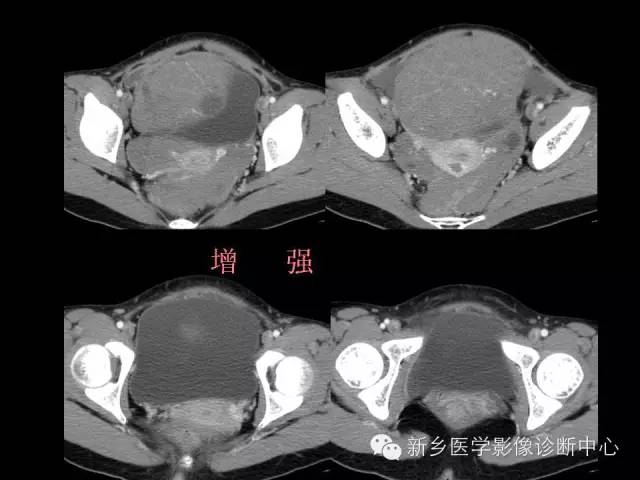 【病例】卵巢颗粒细胞瘤1例MR影像表现与鉴别
