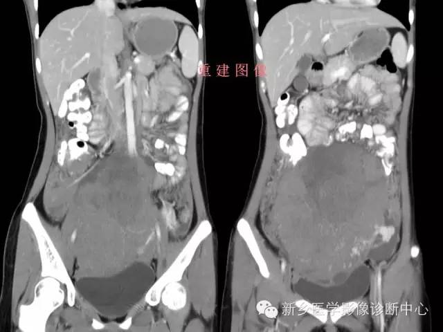 【病例】卵巢颗粒细胞瘤1例MR影像表现与鉴别