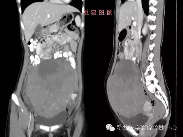 【病例】卵巢颗粒细胞瘤1例MR影像表现与鉴别