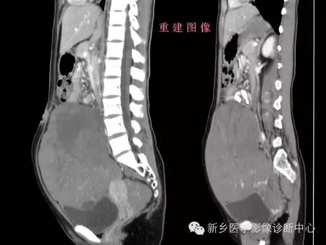 【病例】卵巢颗粒细胞瘤1例MR影像表现与鉴别