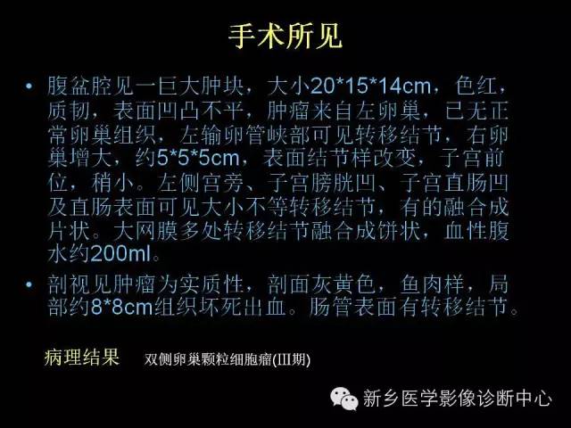 【病例】卵巢颗粒细胞瘤1例MR影像表现与鉴别