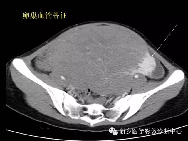 【病例】卵巢颗粒细胞瘤1例MR影像表现与鉴别