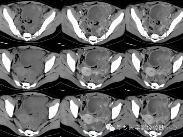 【病例】盆腔胚胎型横纹肌肉瘤1例CT影像表现与鉴别
