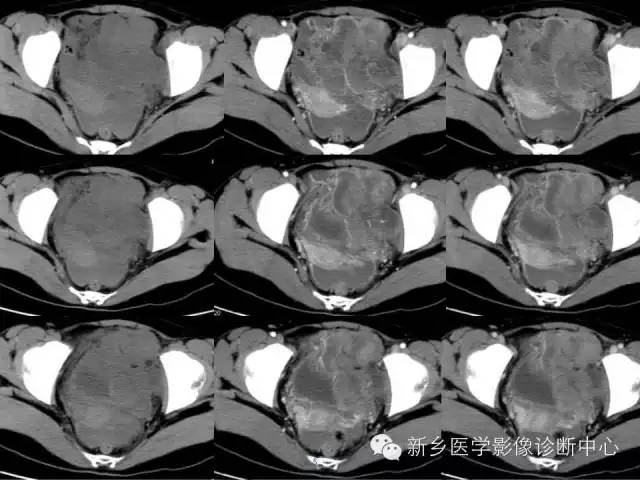 【病例】盆腔胚胎型横纹肌肉瘤1例CT影像表现与鉴别