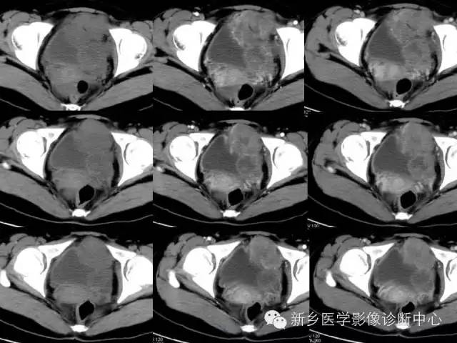 【病例】盆腔胚胎型横纹肌肉瘤1例CT影像表现与鉴别