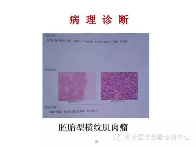 【病例】盆腔胚胎型横纹肌肉瘤1例CT影像表现与鉴别
