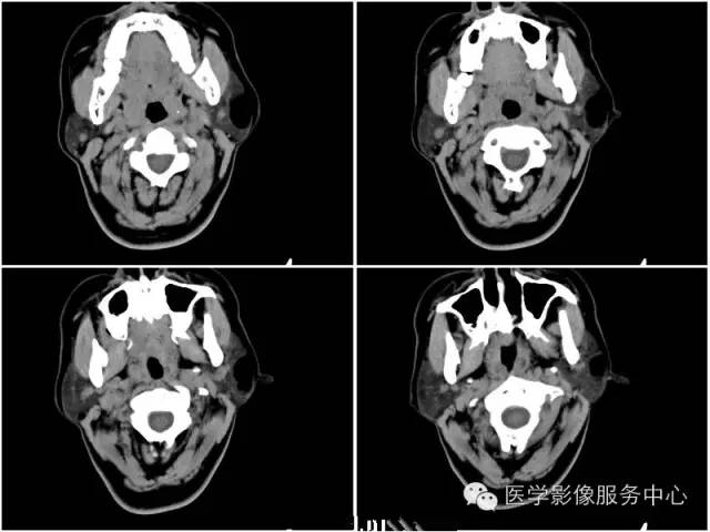 【病例】腮腺脂肪瘤1例CT影像表现 【病例】腮腺脂肪瘤1例CT影像表现