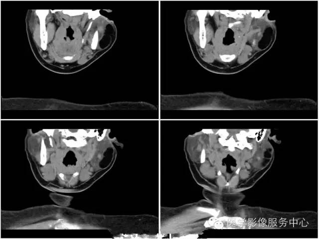 【病例】腮腺脂肪瘤1例CT影像表现 【病例】腮腺脂肪瘤1例CT影像表现