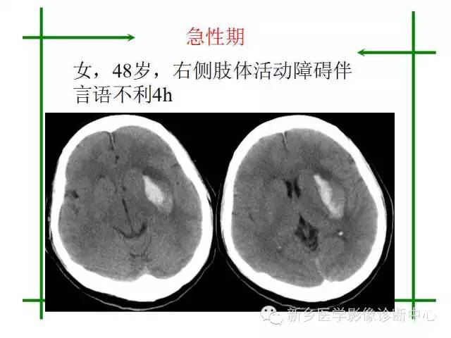 脑出血的CT和磁共振分期图解