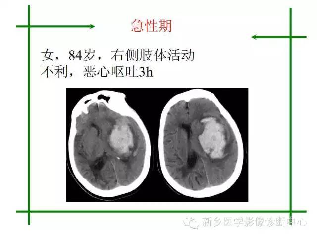 脑出血的CT和磁共振分期图解