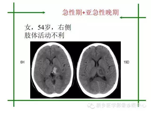 脑出血的CT和磁共振分期图解