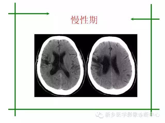 脑出血的CT和磁共振分期图解