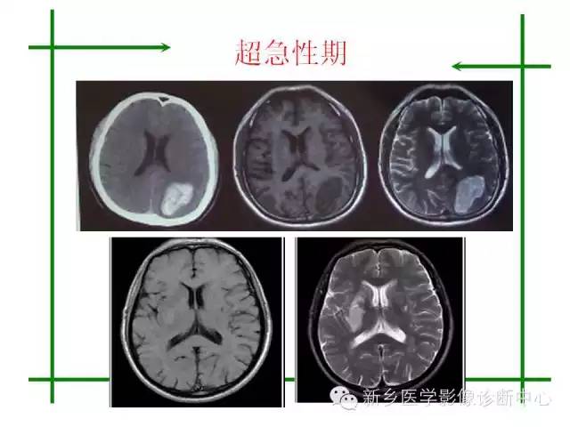 脑出血的CT和磁共振分期图解