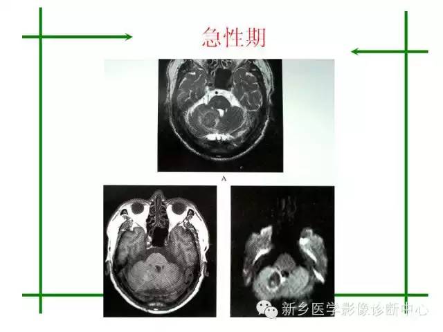 脑出血的CT和磁共振分期图解