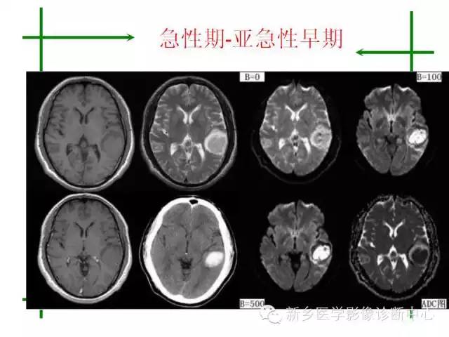 脑出血的CT和磁共振分期图解