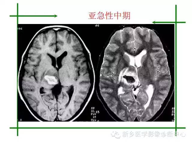 脑出血的CT和磁共振分期图解